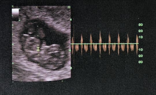 24 tydzień ciąży zdjęcie z usg