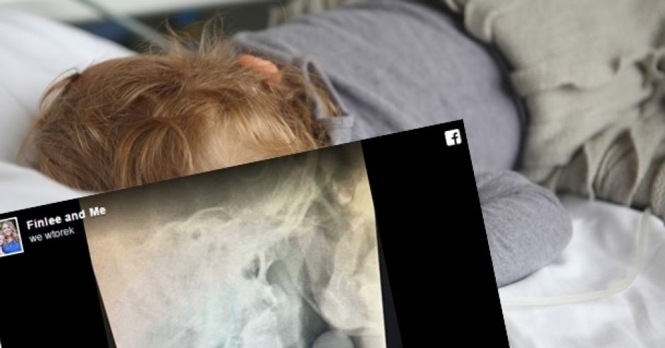5-letni chłopiec zakrztusił się winogronem
