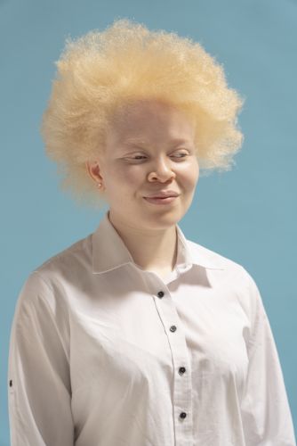albinos