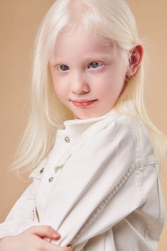 Albinizm, albinos