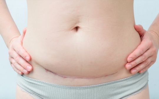 blizna po cesarskim cięciu zdjęcia nieładna blizna po cc