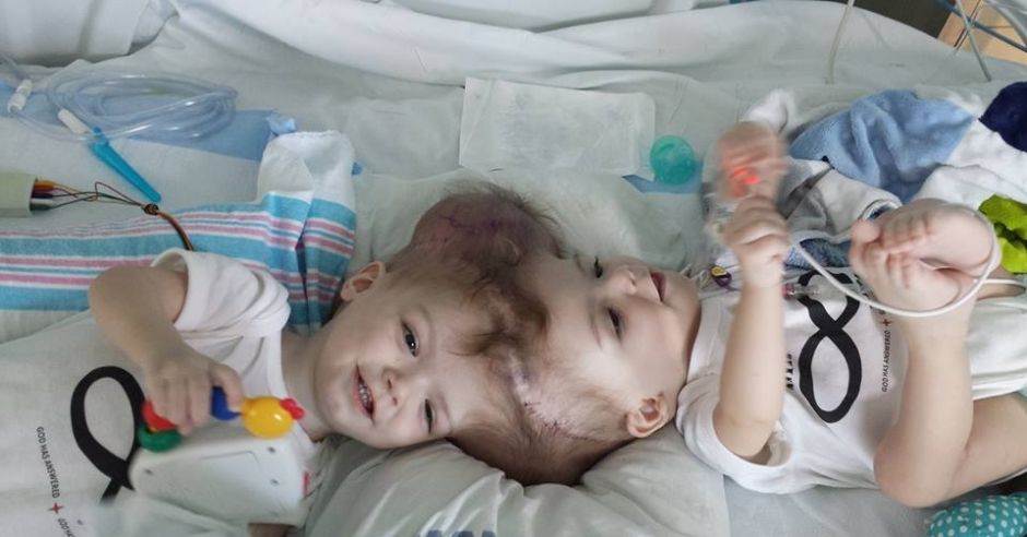 Bliźnięta syjamskie, Jadon i Anias McDonald, przed operacją