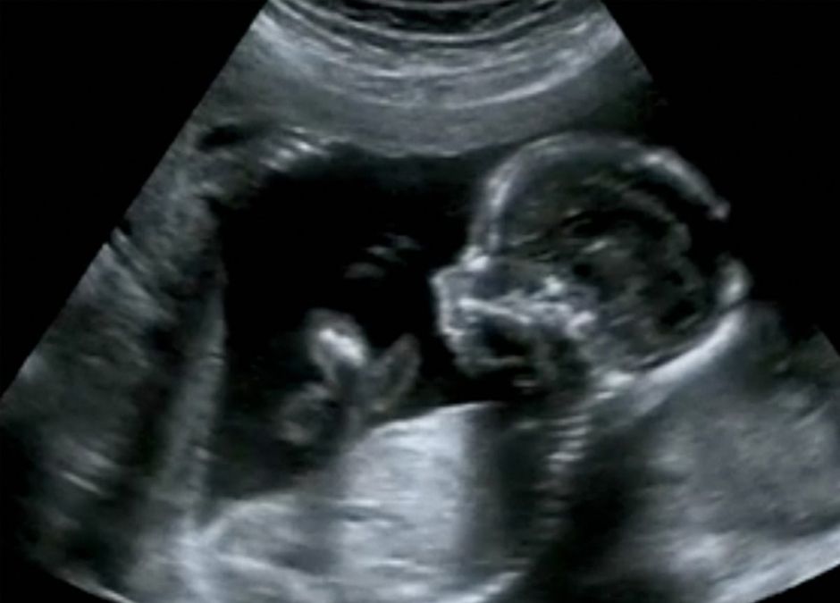 fetus in fetu