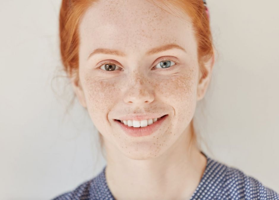 heterochromia