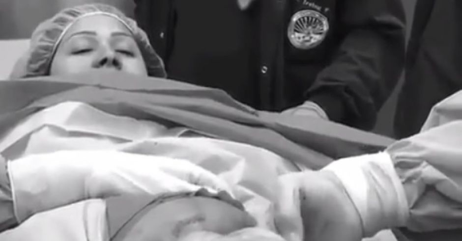 Jak wygląda poród przez cesarskie cięcie przy ułożeniu pośladkowym dziecka