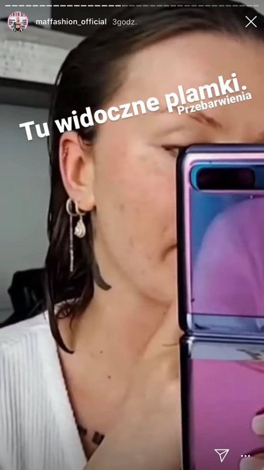 Maffashion podzieliła się zdjęciami swoich przebarwień