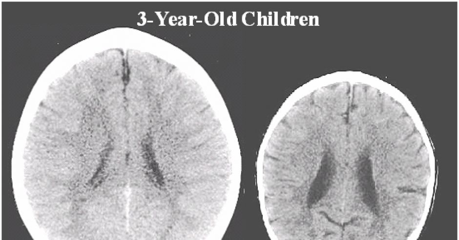 Mózgi dzieci normalnych i zaniedbanych