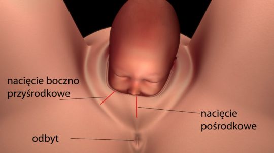 Naci Cie Krocza Podczas Porodu Jak Wygl Da Czy Boli Kiedy Jest Konieczne Mamotoja Pl