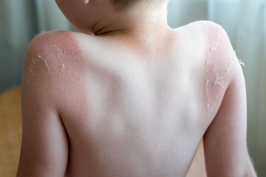 oparzenie słoneczne ile trwa łuszcząca się skóra