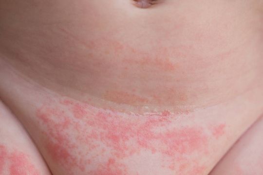 Pieluszkowe zapalenie skóry na brzuszku