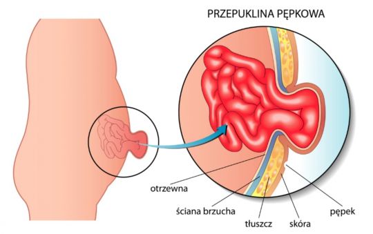 przepuklina pępkowa w ciąży