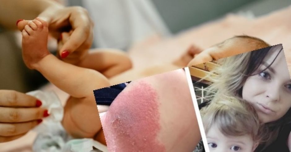 Reakcja alergiczna od pieluszki