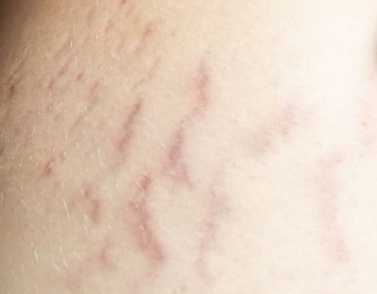 Jak wyglądają czerwone rozstępy na piersiach?