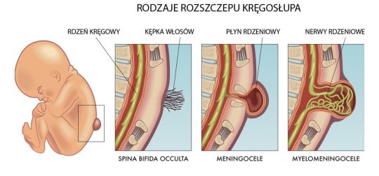 rozszczep kręgosłupa ilustracja