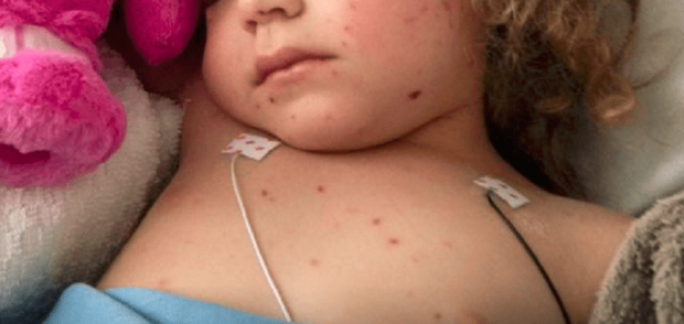 screen/Facebook Jazmyn's meningococcal B journey