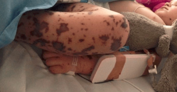 screen/Facebook Jazmyn's meningococcal B journey