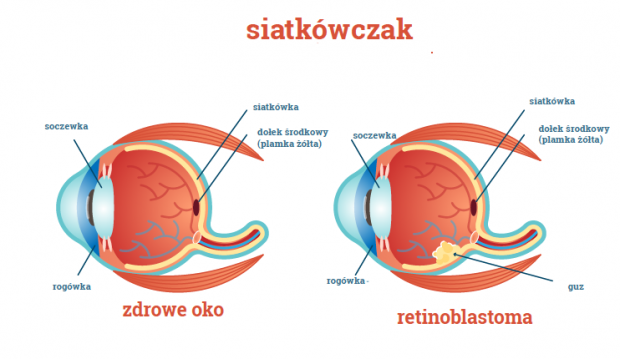 zdrowe oko i oko z siatkówczakiem infografika