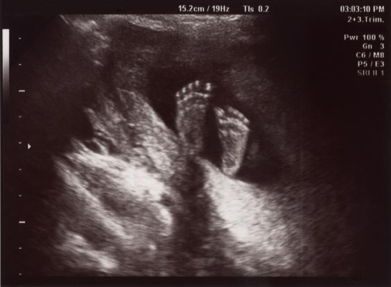 zdjęcie USG 22 tygodniowego dziecka