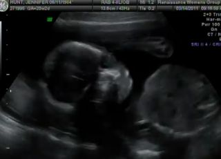USG w ciąży, 20 tydzień ciąży, rozwój płodu, rozwój ciąży
