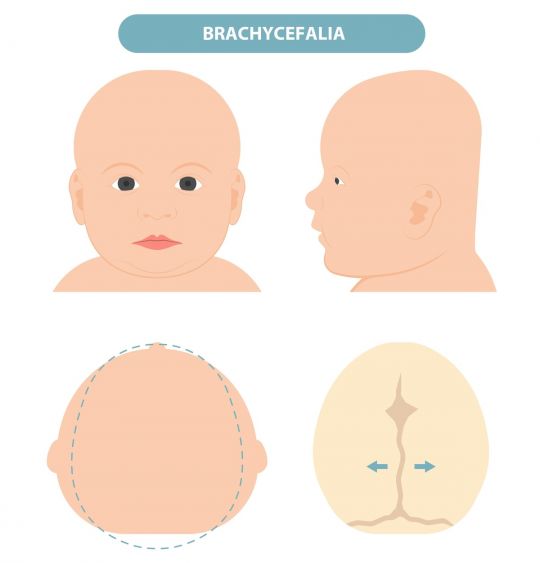 zniekształcenie główki niemowlaka brachycefalia